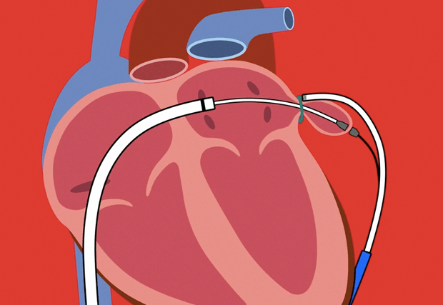 Watch Can This Common Blood Thinner Prevent Stroke video Watch Can This Common Blood Thinner Prevent Stroke video