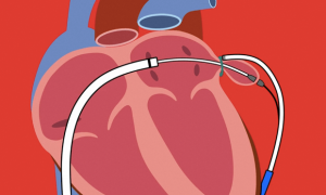 Northwest Texas Healthcare System First to Perform LARIAT Procedure in Amarillo