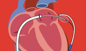 Northwest Texas Healthcare System First to Perform LARIAT Procedure in Amarillo